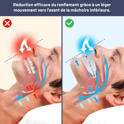 Gouttière anti - ronflement réglable SilentNight - Rondor